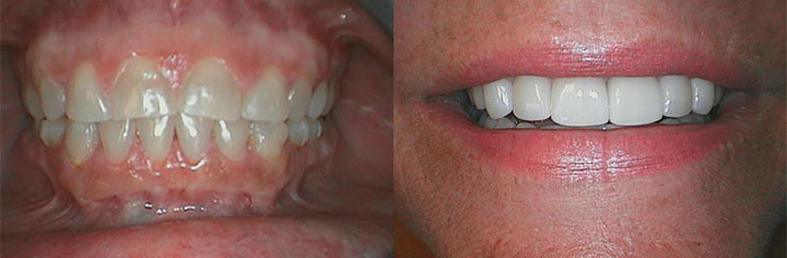 before & after treatment