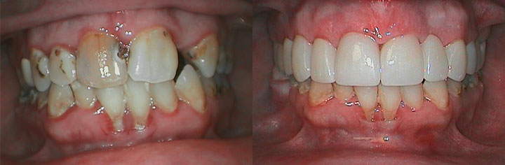 before & after treatment